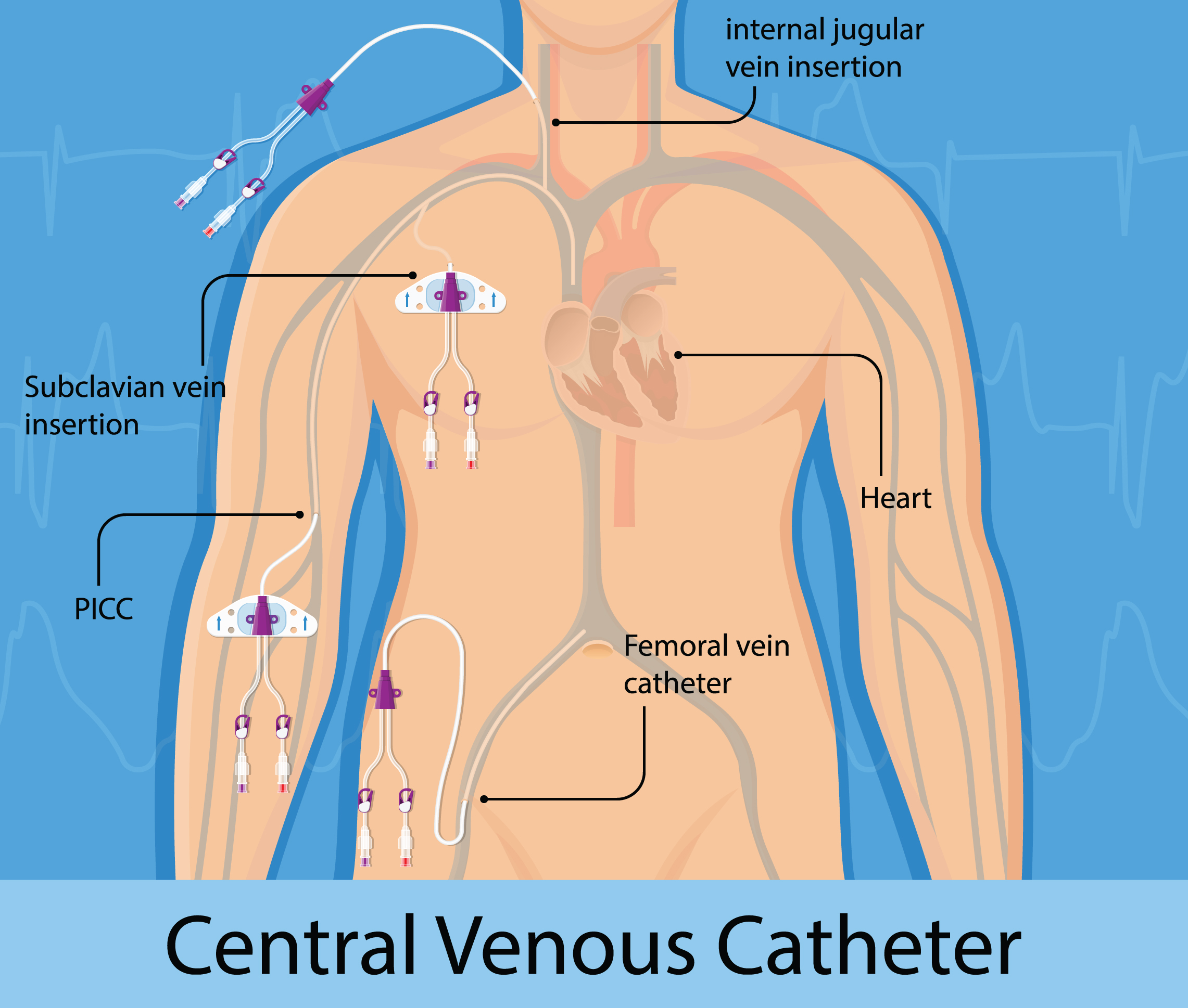 What Are Central Venous Catheters